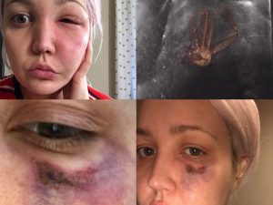 Meghan Linsey Suffers Nasty Brown Recluse Spider Bite